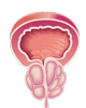 Benign Prostatic Hyperplasia