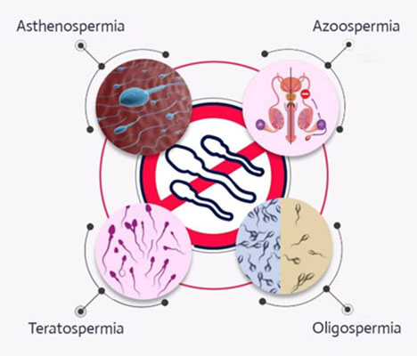 Male Infertility Treatment