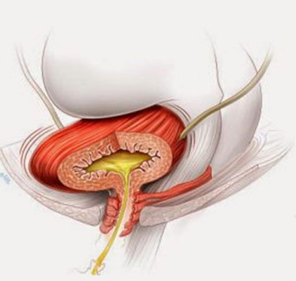 Neurogenic Bladder