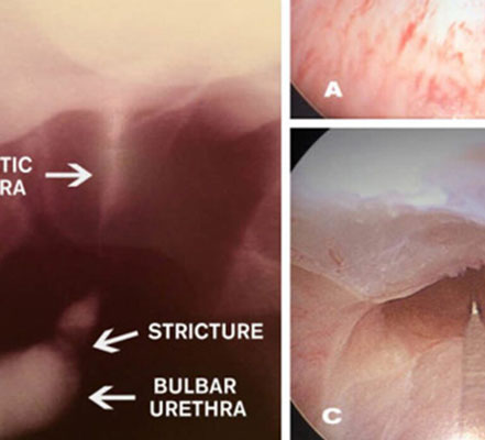 Urethral Stricture Disease