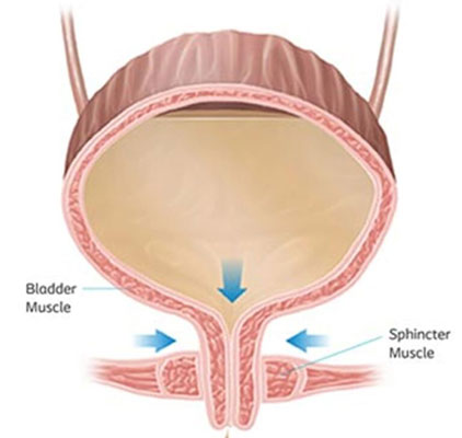 Urinary Incontinence Problems