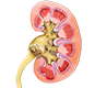 Hydrocele in Raipur